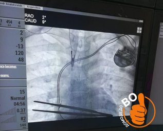 ​В Домодедовской больнице впервые установили постоянный кардиостимулятор пациенту