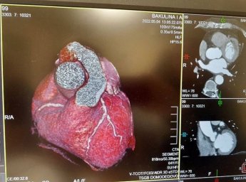 В Домодедово внедрён метод перфузионной компьютерной томографии сердца и головного мозга